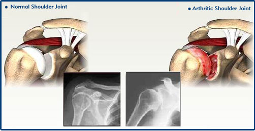 Arthritis