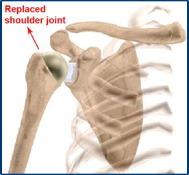 Replaced Shoulder Joint